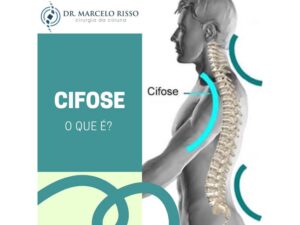 Dr Marcelo Risso - Cifose