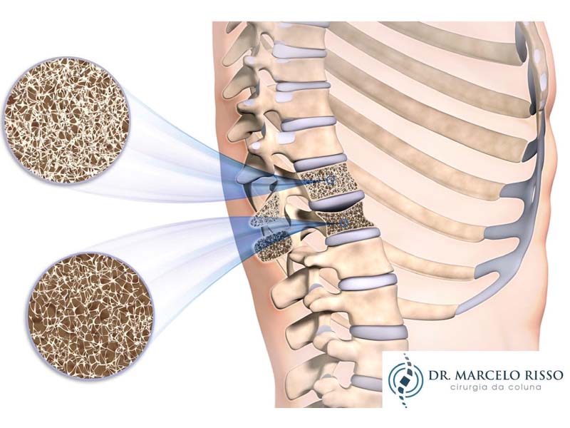 dr marcelo fraturas coluna osteoporose