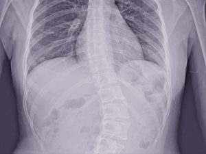 Scoliosis film x ray show spinal bend in teenager patient. Scoli