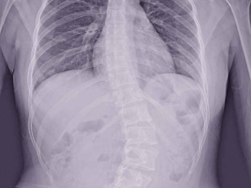 Scoliosis film x ray show spinal bend in teenager patient. Scoli