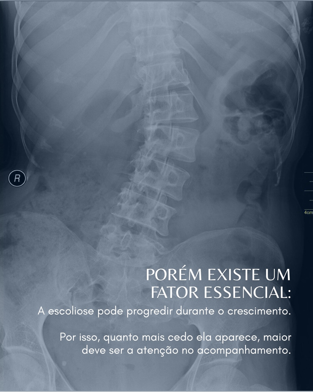 dr marcelo slide escoliose 04